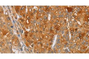 Immunohistochemistry of paraffin-embedded Human liver cancer tissue using ARSG Polyclonal Antibody at dilution 1:30 (ARSG antibody)