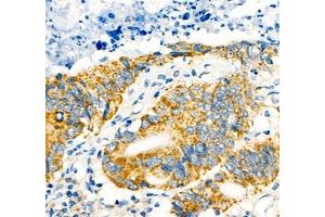 Immunohistochemistry of paraffin embedded human colon cancer using Notch4 (ABIN7074863) at dilution of 1:600 (400x lens) (NOTCH4 antibody)