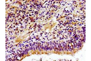 Immunohistochemistry of paraffin-embedded human lung cancer using ABIN7147616 at dilution of 1:100 (Choline Kinase alpha antibody  (AA 79-173))