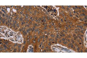 Immunohistochemistry of paraffin-embedded Human lung cancer using Catenin gamma Polyclonal Antibody at dilution of 1:40 (JUP antibody)