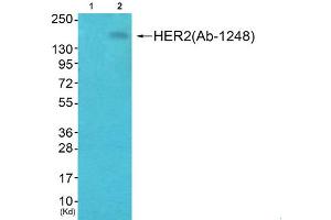 Immunohistochemical analysis of paraffin-embedded human breast carcinoma tissue, using HER2 (phospho-Tyr1248) antibody.