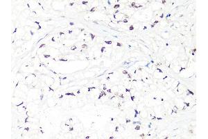 Immunohistochemistry of paraffin-embedded human gastric cancer using MTA2 Antibody (ABIN5998268) at dilution of 1/100 (40x lens). (MTA2 antibody)