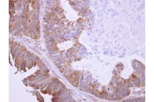 IHC-P Image BHMT antibody detects BHMT protein at cytosol on human colon carcinoma by immunohistochemical analysis. (BHMT antibody)