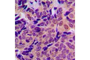 Immunohistochemical analysis of Beta Amyloid (pT743) staining in human breast cancer formalin fixed paraffin embedded tissue section. (beta Amyloid antibody  (C-Term, pSer743))