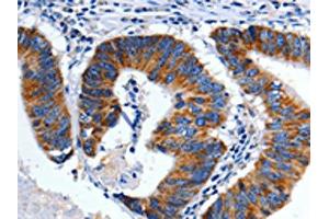 The image on the left is immunohistochemistry of paraffin-embedded Human colon cancer tissue using ABIN7128939(CHRM2 Antibody) at dilution 1/3, on the right is treated with fusion protein. (Muscarinic Acetylcholine Receptor M2 antibody)