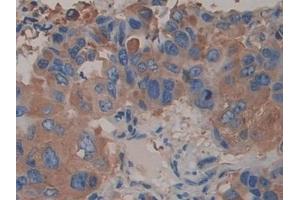 Detection of ACTN4 in Human Breast cancer Tissue using Polyclonal Antibody to Actinin Alpha 4 (ACTN4) (alpha Actinin 4 antibody  (AA 1-269))