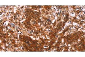 Immunohistochemistry of paraffin-embedded Human gastric cancer using HAS1 Polyclonal Antibody at dilution of 1:30 (HAS1 antibody)