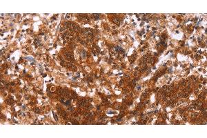 Immunohistochemistry of paraffin-embedded Human gastric cancer using HAS1 Polyclonal Antibody at dilution of 1:30 (HAS1 antibody)
