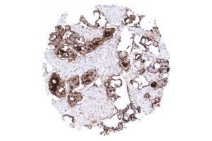 Ovary Strong predominantly membranous mesothelin staining in an endometroid ovarian cancer (Mesothelin antibody  (AA 273-407))