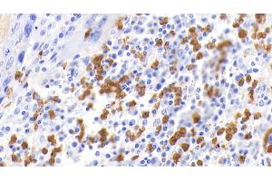 Detection of CALPRO in Human Lymphoma Tissue using Polyclonal Antibody to Calprotectin (CALPRO) (S100A8/A9 Complex (Calprotectin) antibody  (AA 1-114))