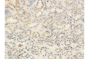 ABIN6263150 and ABIN6278791 at 1/100 staining human renal cell carcinoma by IHC-P. (MBIP antibody  (Internal Region))