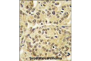 Formalin-fixed and paraffin-embedded human prostata carcinoma tissue reacted with TIEG antibody , which was peroxidase-conjugated to the secondary antibody, followed by DAB staining. (KLF10/TIEG1 antibody  (N-Term))
