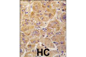 Formalin-fixed and paraffin-embedded human hepatocellular carcinoma reacted with ALDH1A1 polyclonal antibody  , which was peroxidase-conjugated to the secondary antibody, followed by DAB staining.