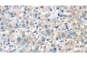 Immunohistochemistry of paraffin-embedded Human liver cancer tissue using PLXNA2 Polyclonal Antibody at dilution 1:40 (Plexin A2 antibody)