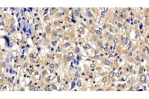 Detection of Bcl2L2 in Human Liver cancer Tissue using Polyclonal Antibody to B-Cell CLL/Lymphoma 2 Like Protein 2 (Bcl2L2) (BCL2L2 antibody  (AA 2-193))