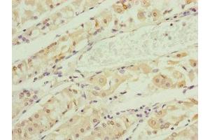 Immunohistochemistry of paraffin-embedded human gastric cancer using ABIN7151148 at dilution of 1:100 (RNF135 antibody  (AA 339-432))