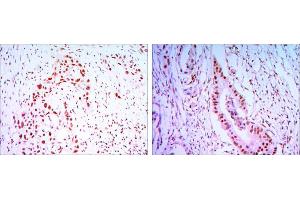 Immunohistochemical analysis of paraffin-embedded lung cancer tissues (left) and colon cancer tissues (right) using CDC27 antibody with DAB staining. (CDC27 antibody)