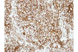 IHC-P Image Immunohistochemical analysis of paraffin-embedded human lung adenocarcinoma, using HLA-DRB1, antibody at 1:500 dilution. (HLA-DRB1 antibody)