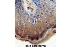 TJ antibody (N-term) 0762a immunohistochemistry analysis in formalin fixed and paraffin embedded human skin carcinoma followed by peroxidase conjugation of the secondary antibody and DAB staining. (TJAP1 antibody  (N-Term))