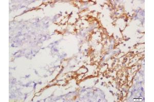 Formalin-fixed and paraffin embedded human lung carcinoma labeled with Anti-IL-13Ra2 Polyclonal Antibody, Unconjugated (ABIN740610) at 1:300 followed by conjugation to the secondary antibody and DAB staining. (IL13RA2 antibody  (AA 81-180))