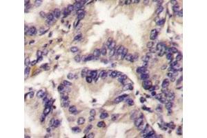 IHC analysis of FFPE human lung carcinoma tissue stained with VEGFC antibody (VEGFC antibody  (AA 248-277))