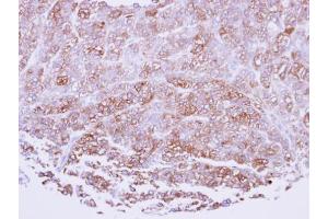 IHC-P Image Immunohistochemical analysis of paraffin-embedded human breast cancerncer, using ICAM2, antibody at 1:100 dilution.