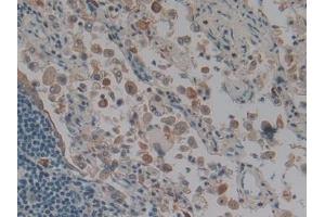 DAB staining on IHC-P; Samples: Human Lung cancer Tissue (Keratin 3 antibody  (AA 198-514))