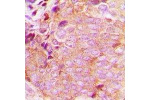 Immunohistochemical analysis of CaMKK beta staining in human breast cancer formalin fixed paraffin embedded tissue section. (CAMKK2 antibody)