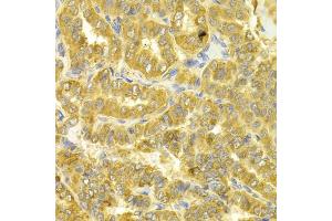 Immunohistochemistry of paraffin-embedded human thyroid cancer using DLD Antibody (ABIN5973132) at dilution of 1/100 (40x lens). (DLD antibody)