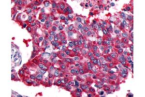 Anti-CALCRL / CGRP Receptor antibody IHC of human Lung, Non-Small Cell Carcinoma. (CALCRL antibody  (Cytoplasmic Domain))