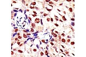 IHC analysis of FFPE human breast carcinoma tissue stained with the PRMT2 antibody
