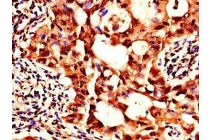 Immunohistochemistry of paraffin-embedded human lung cancer using ABIN7169181 at dilution of 1:100 (SIK1 antibody  (AA 492-750))