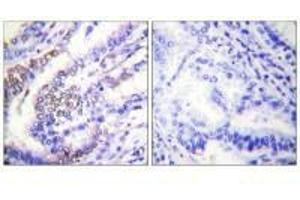 Immunohistochemical analysis of paraffin-embedded human lung carcinoma tissue using Cyclin E1 antibody. (Cyclin E1 antibody)