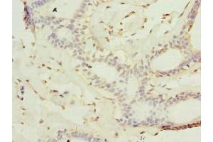 Immunohistochemistry of paraffin-embedded human breast cancer using ABIN7157236 at dilution of 1:100 (KATNAL2 antibody  (AA 18-307))