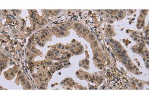 Immunohistochemistry of paraffin-embedded Human gastric cancer tissue using MCC Polyclonal Antibody at dilution 1:30 (MCC antibody)