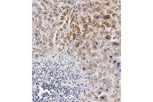 Immunohistochemical analysis of paraffin-embedded Human hepatocarcinoma tissue using (ABIN654629 and ABIN2844325) performed on the Leica® BOND RXm. (BCKDHB antibody  (N-Term))