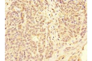 Immunohistochemistry of paraffin-embedded human ovarian cancer using ABIN7158545 at dilution of 1:100 (FCGR2C antibody  (AA 43-223))