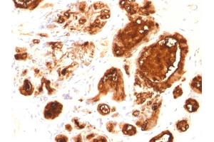 Formalin-fixed, paraffin-embedded human Breast Carcinoma stained with MUC1 Mouse Recombinant Monoclonal Antibody (rMUC1/960). (Recombinant MUC1 antibody)