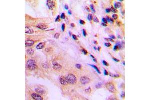 Immunohistochemical analysis of p65 (pT60) staining in human lung cancer formalin fixed paraffin embedded tissue section. (SYT1 antibody  (N-Term, pSer60))