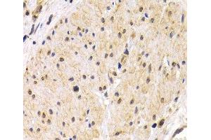 Immunohistochemistry of paraffin-embedded Human stomach cancer using TMPRSS2 Polyclonal Antibody at dilution of 1:200 (40x lens). (TMPRSS2 antibody)