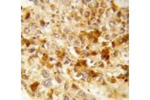 Immunohistochemistry analysis of human hepatocarcinoma (Formalin-fixed, Paraffin-embedded)  using Peroxin 2 / PEX2 / RNF72  Antibody , followed by peroxidase-conjugated secondary antibody and DAB staining. (PEX2 antibody  (Middle Region))