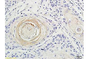 Formalin-fixed and paraffin embedded human oral squamous cell carcinoma labeled with Anti-IL-17 Polyclonal Antibody, Unconjugated (ABIN677933) at 1:200 followed by conjugation to the secondary antibody and DAB staining (IL-17 antibody  (AA 35-130))