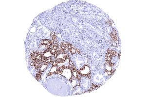 Thyroid CDH16 negative papillary carcinoma invading CDH16 positive normal thyroid CDH16 immunohistochemistry (Recombinant Cadherin-16 antibody)