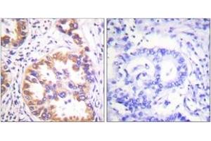 Immunohistochemistry analysis of paraffin-embedded human lung carcinoma, using Tuberin/TSC2 (Phospho-Ser939) Antibody. (Tuberin antibody  (pSer939))