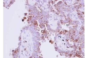 IHC-P Image Immunohistochemical analysis of paraffin-embedded human lung adenocarcinoma, using Ribonuclease A, antibody at 1:250 dilution. (RNASE1 antibody  (Center))