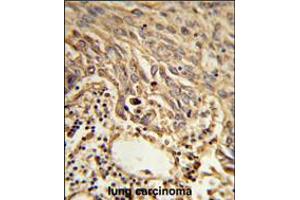 Formalin-fixed and paraffin-embedded human lung carcinoma reacted with EIF4A2 Antibody , which was peroxidase-conjugated to the secondary antibody, followed by DAB staining. (EIF4A2 antibody  (C-Term))