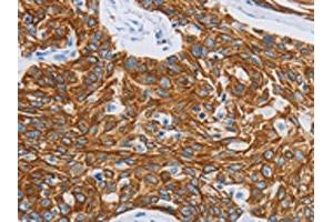 The image on the left is immunohistochemistry of paraffin-embedded Human esophagus cancer tissue using ABIN7191483(MMP21 Antibody) at dilution 1/15, on the right is treated with synthetic peptide. (MMP21 antibody)