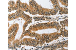 Immunohistochemistry of Human gastric cancer using PIK3R3 Polyclonal Antibody at dilution of 1:45