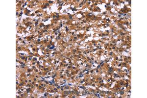 Immunohistochemistry of Human liver cancer using IL1A Polyclonal Antibody at dilution of 1:40 (IL1A antibody)