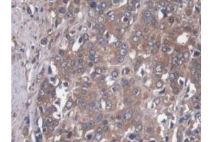 DAB staining on IHC-P; Samples: Human Prostate cancer Tissue (MAP4 antibody  (AA 243-549))